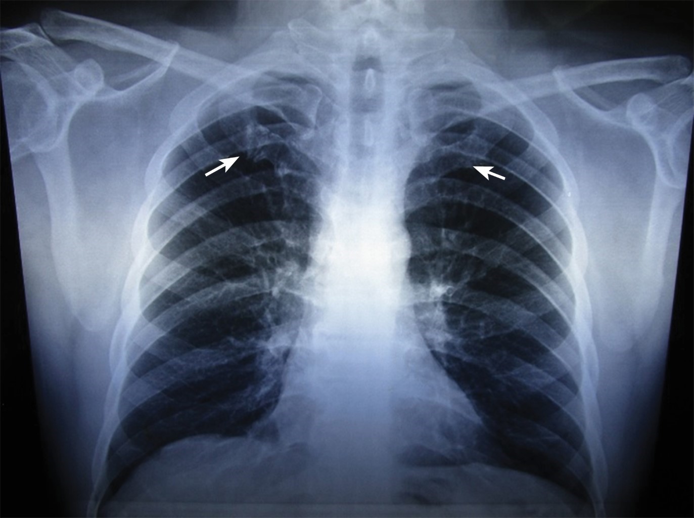 1st Costochondral Junction