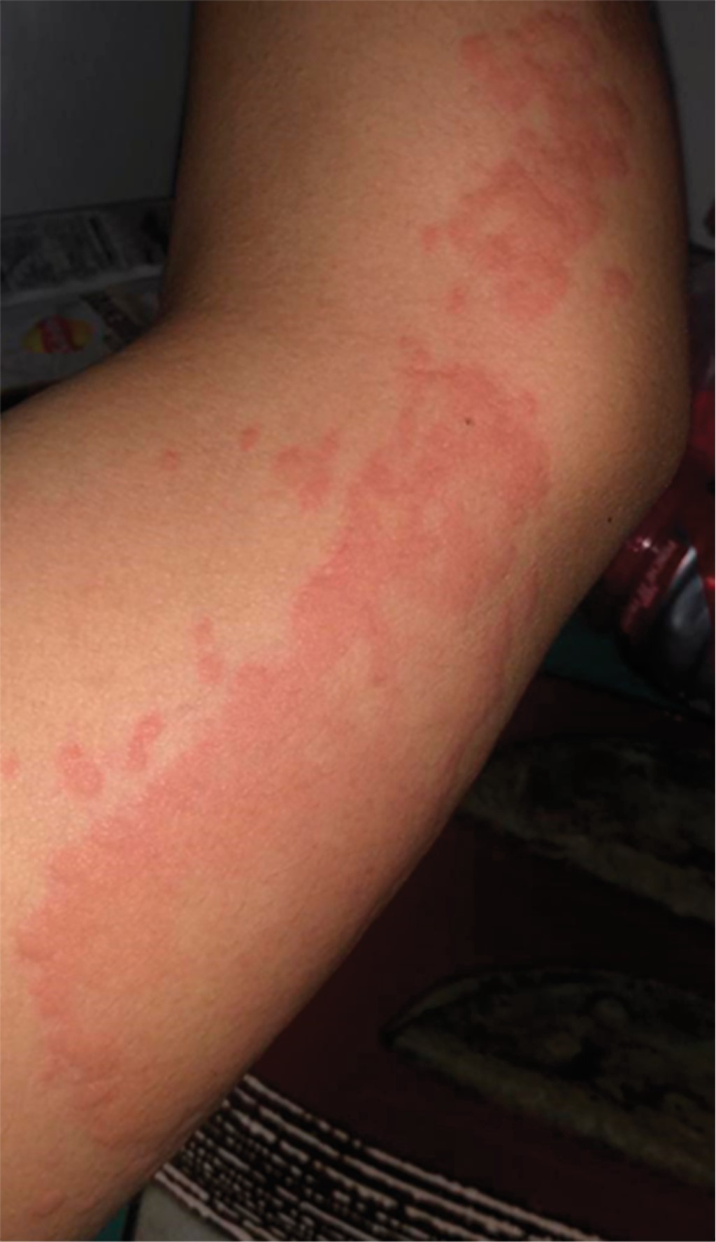 Allergic reaction to articaine with tolerance to lidocaine