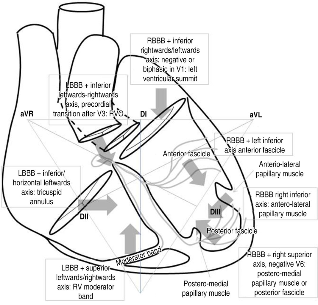 Deductive analysis of the electrocardiogram to determine the site of