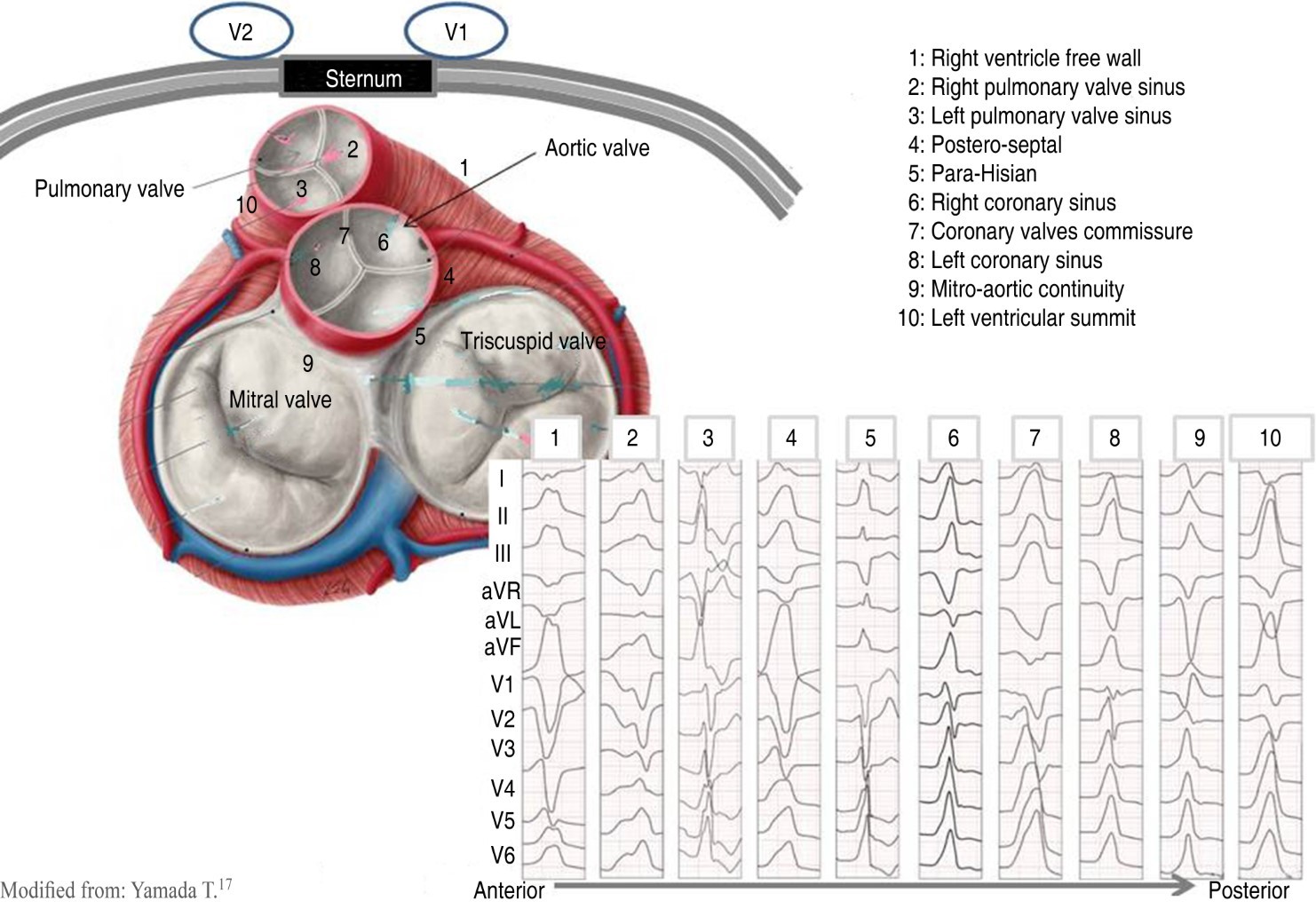 Deductive analysis of the electrocardiogram to determine the site of