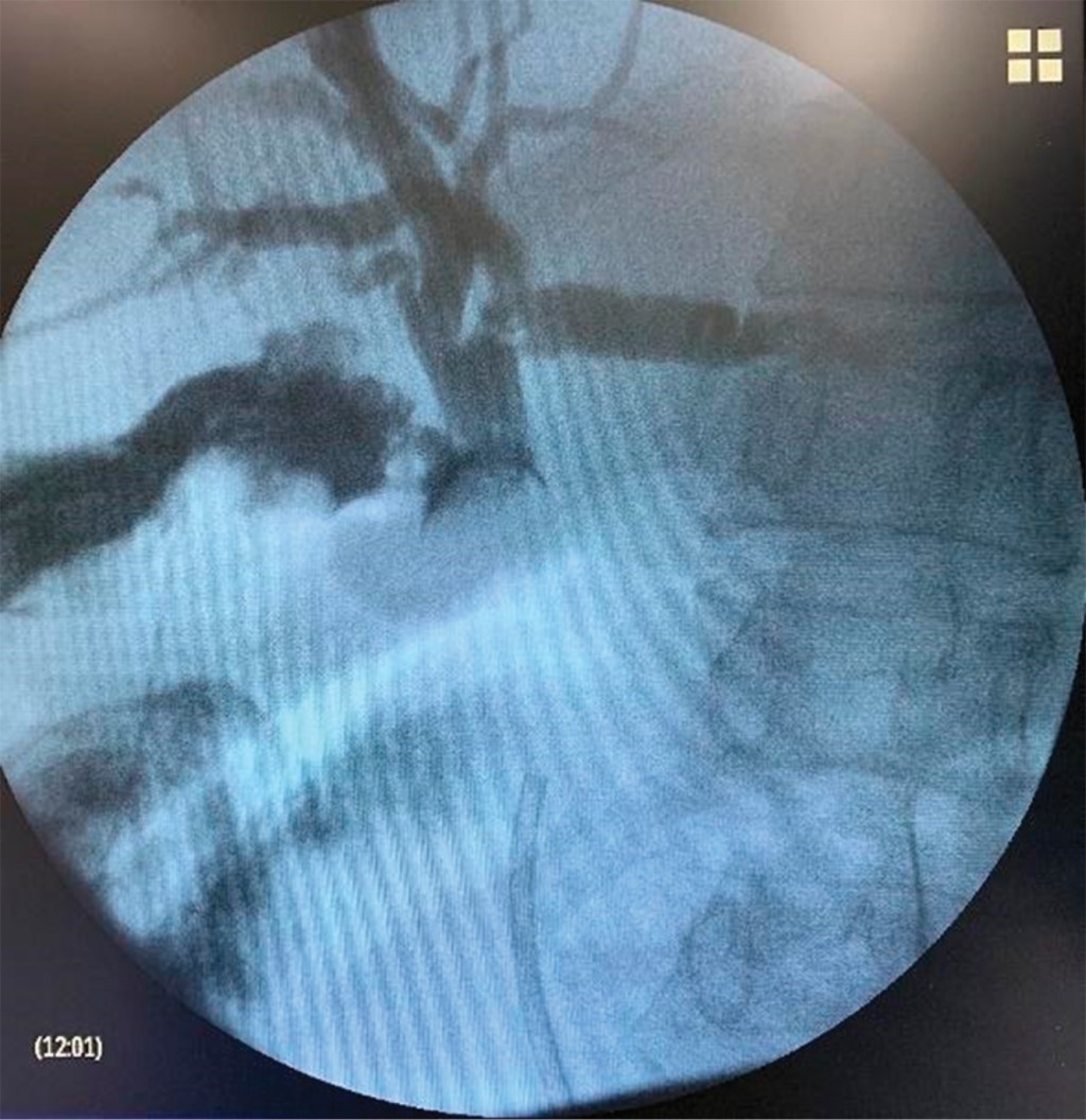 Perforación del colon sigmoides secundaria a migración de endoprótesis