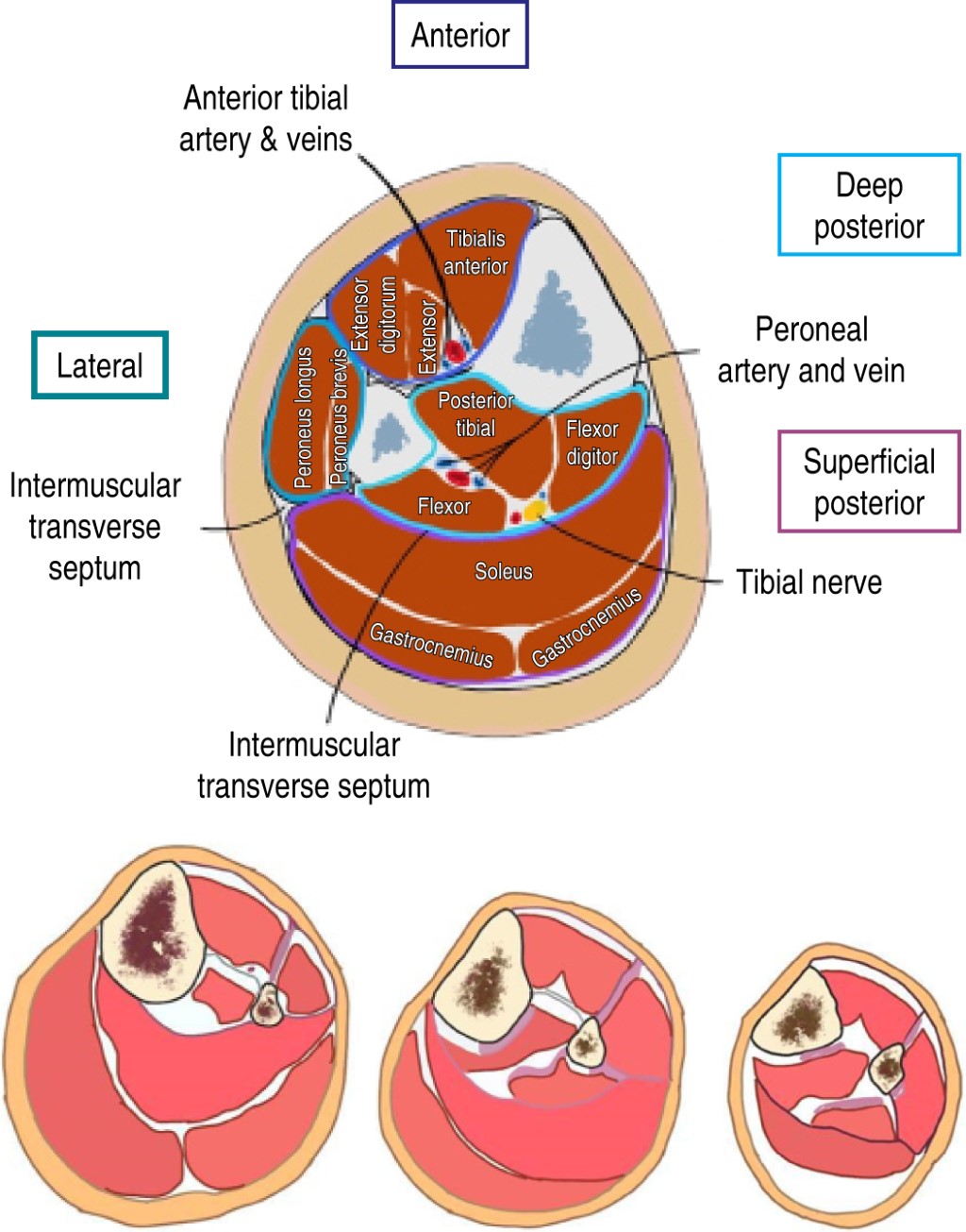 Compartment syndrome in the extremities