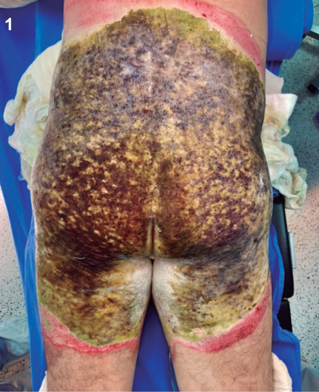 MorelLavallée lesion in burned patients