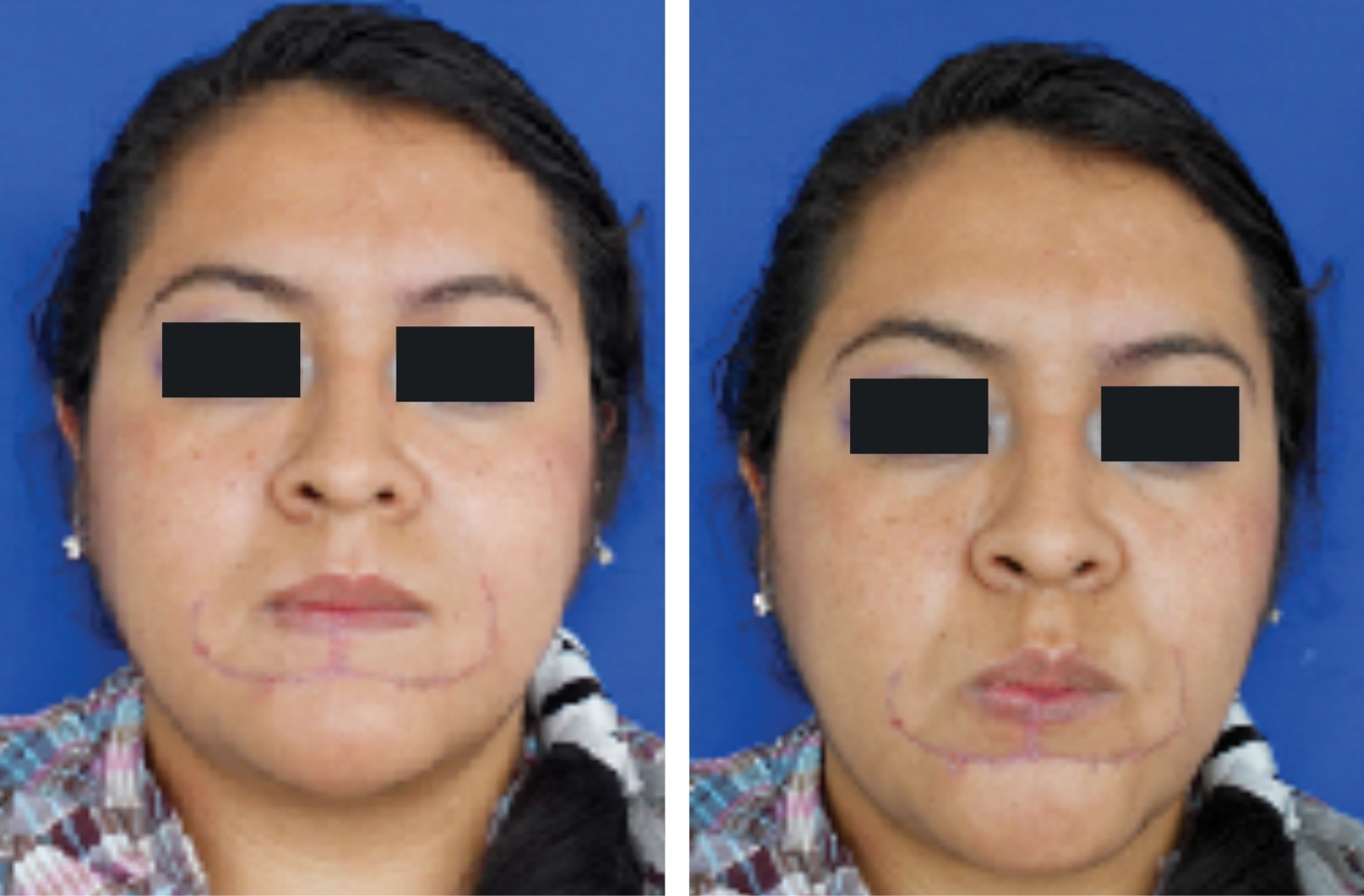 Reconstrucción labial inferior con colgajo de Karapandzic