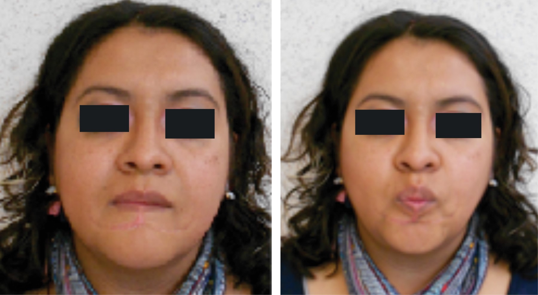 Reconstrucción labial inferior con colgajo de Karapandzic