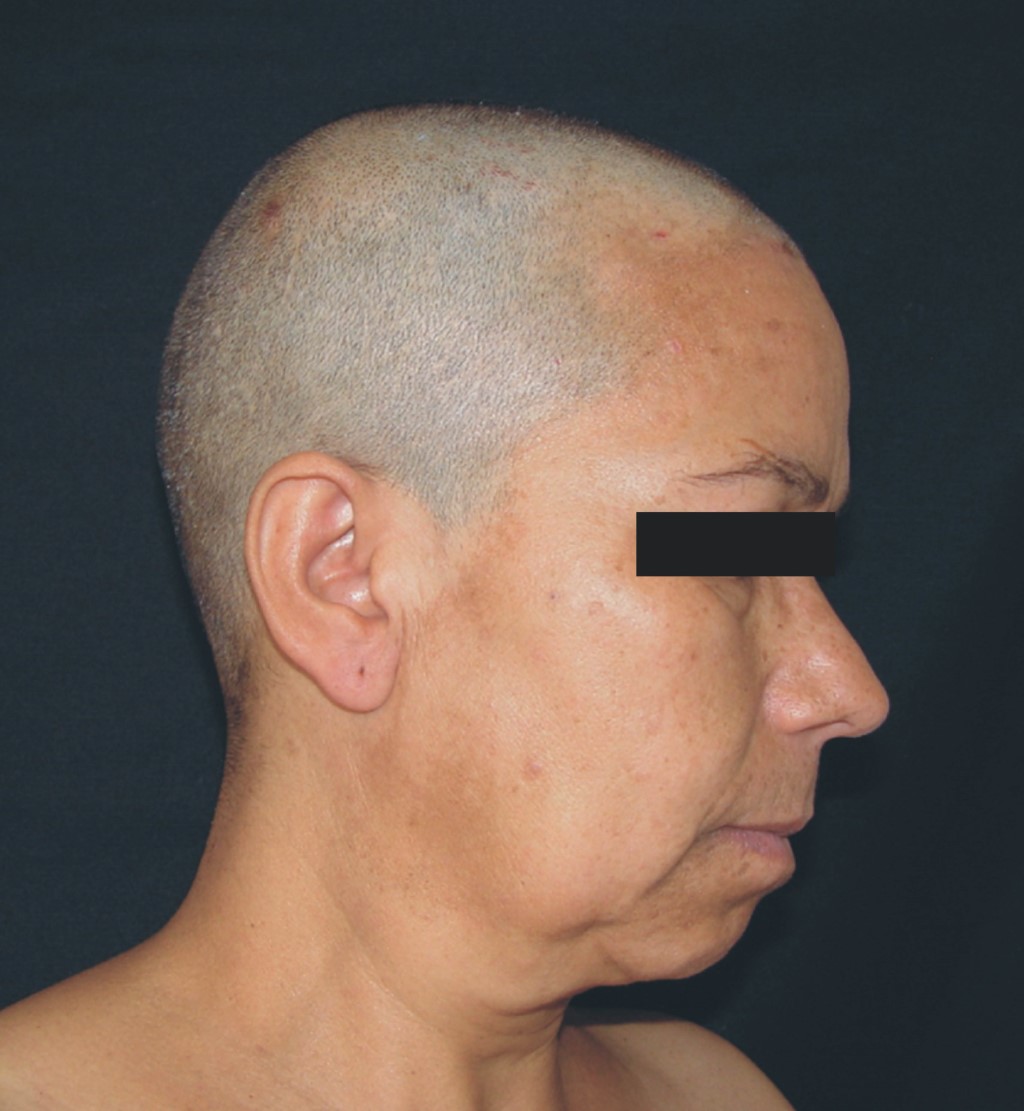 S ndrome De Ekbom delirio De Parasitosis Un V nculo Entre S ndrome De Ekbom delirio De Parasitosis Un V nculo Entre