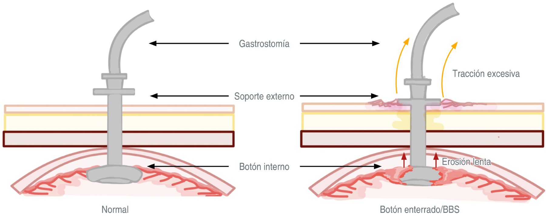 Buried bumper syndrome clinical case of a complication due to