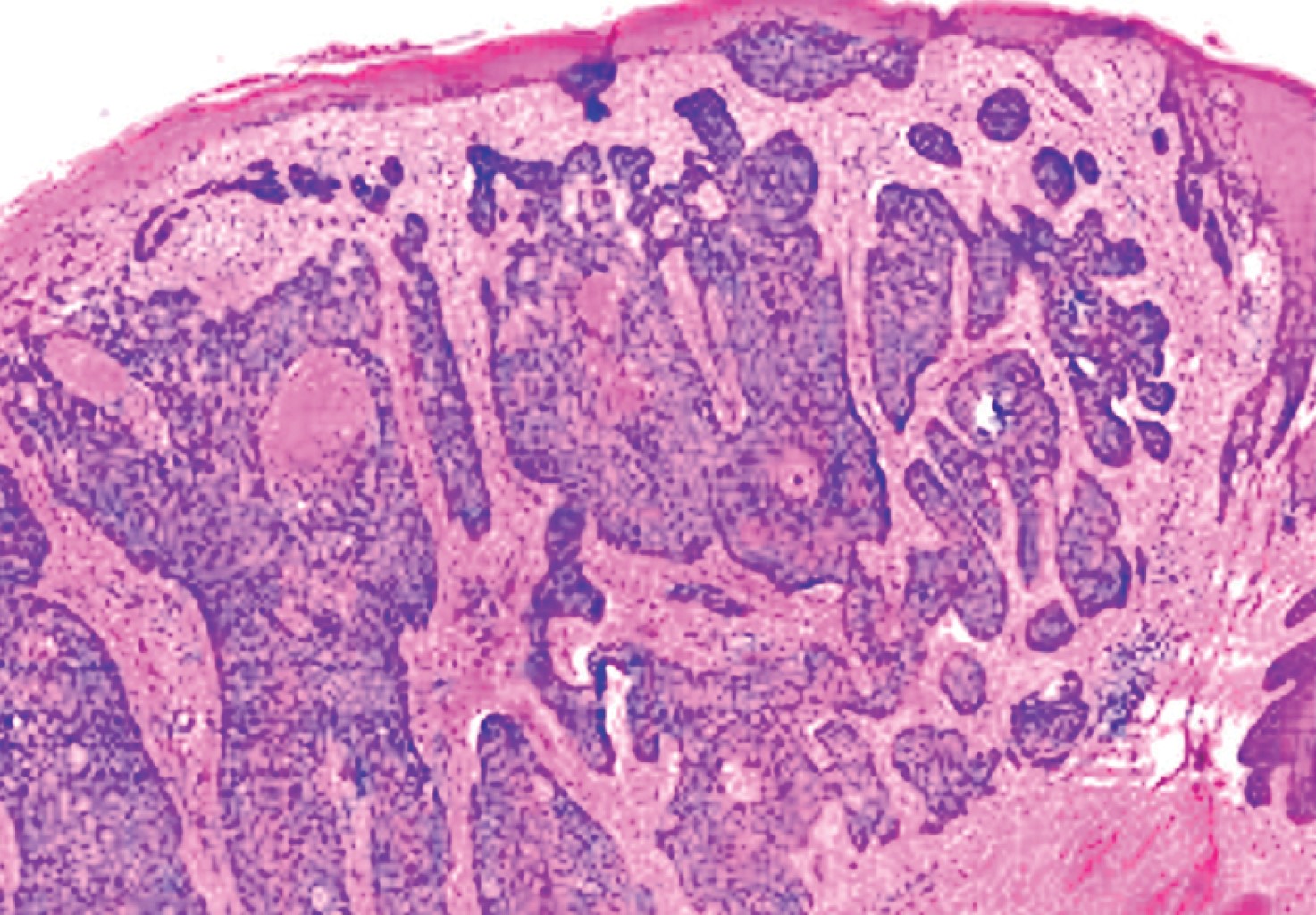 Basal cell carcinoma in the vulvar region. A case of exception