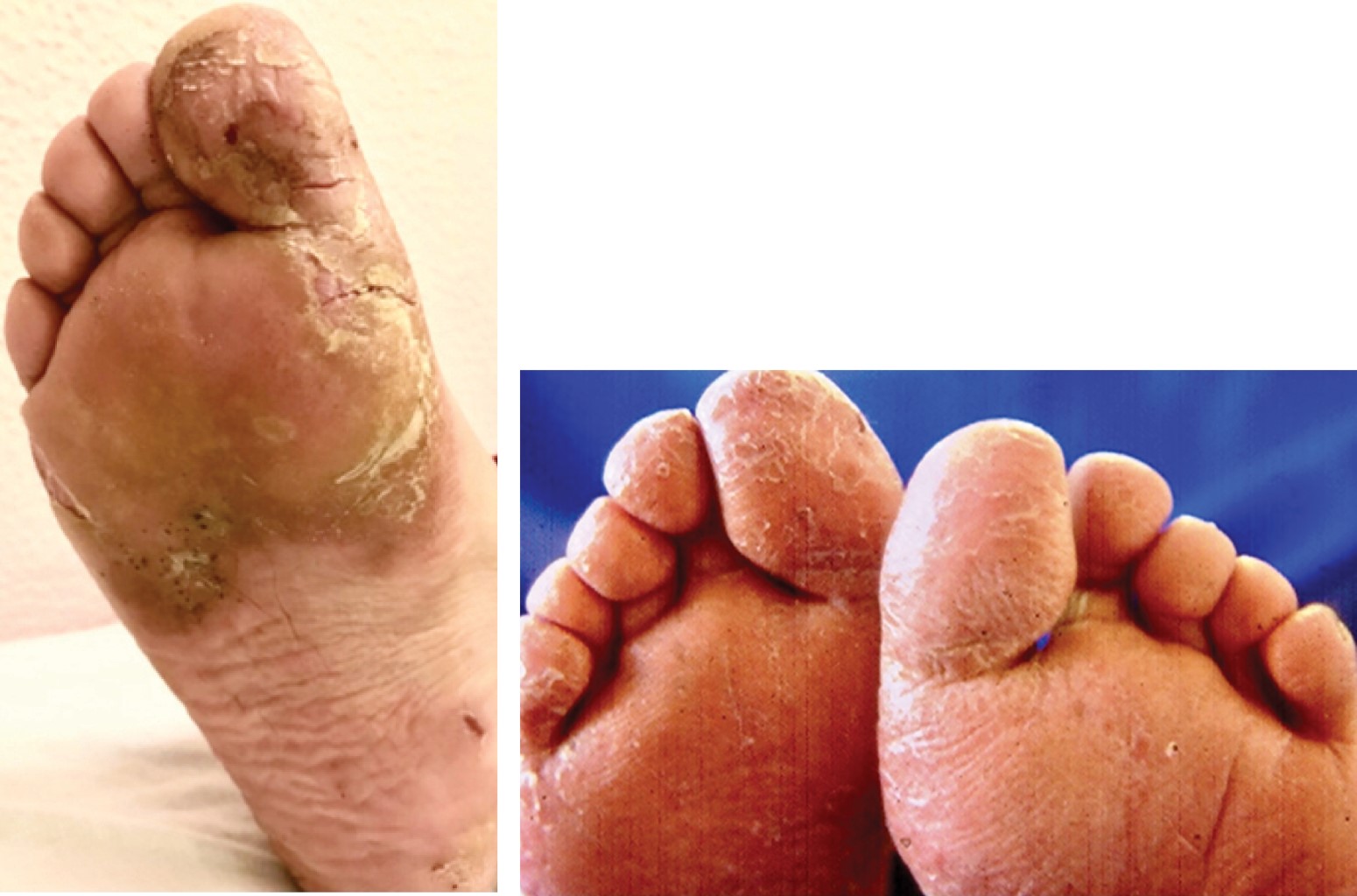 Dermatitis plantar juvenil. afección cutánea poco identificada