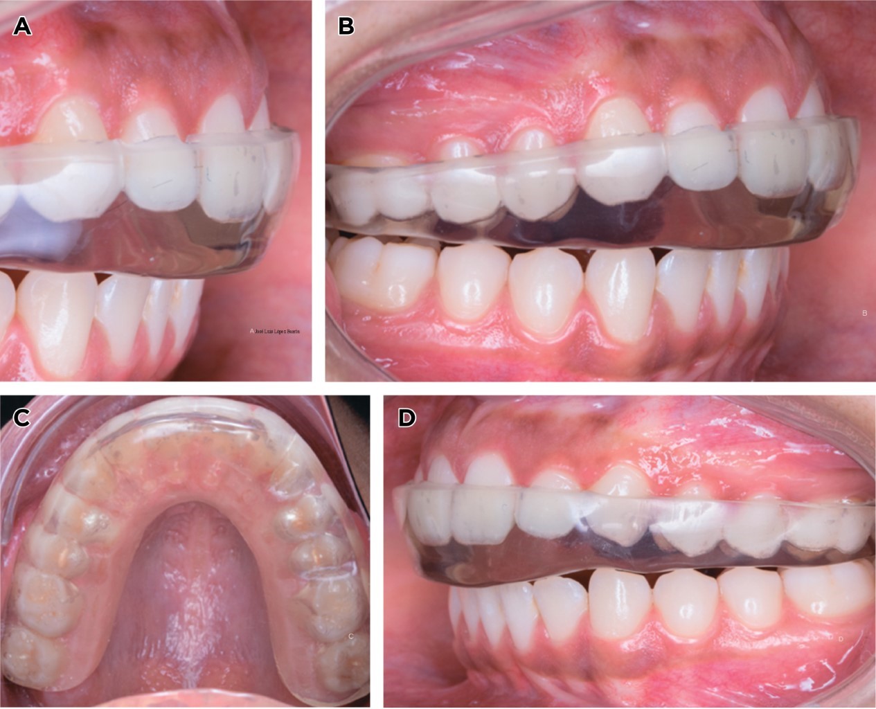 Elaboration of an occlusal guard by digital workflow in idiopathic