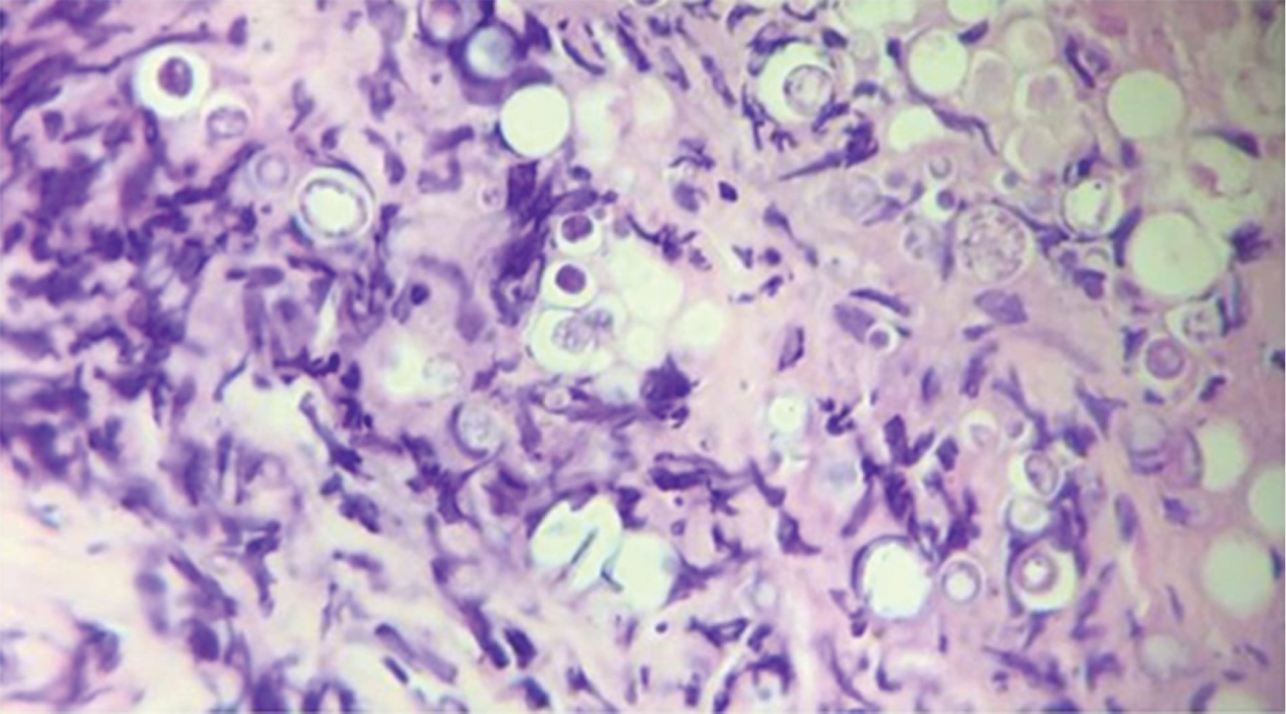 Paracoccidiodomycosis in pediatric population: literature review