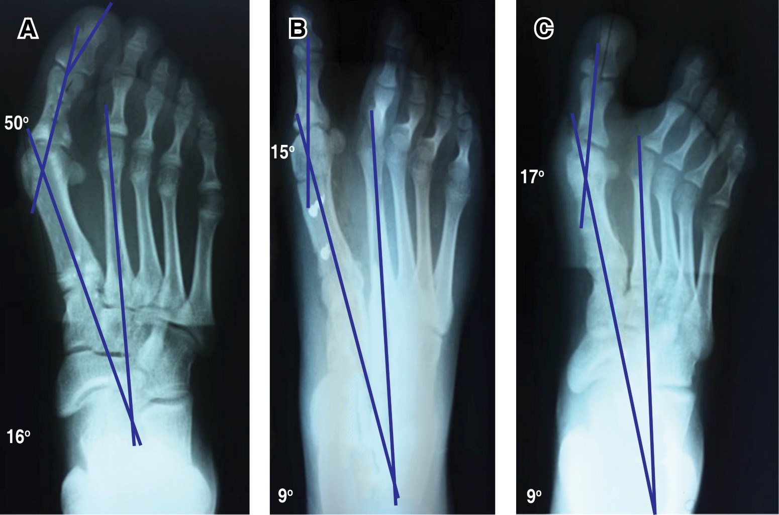 Resultados radiográficos del tratamiento del hallux valgus juvenil con
