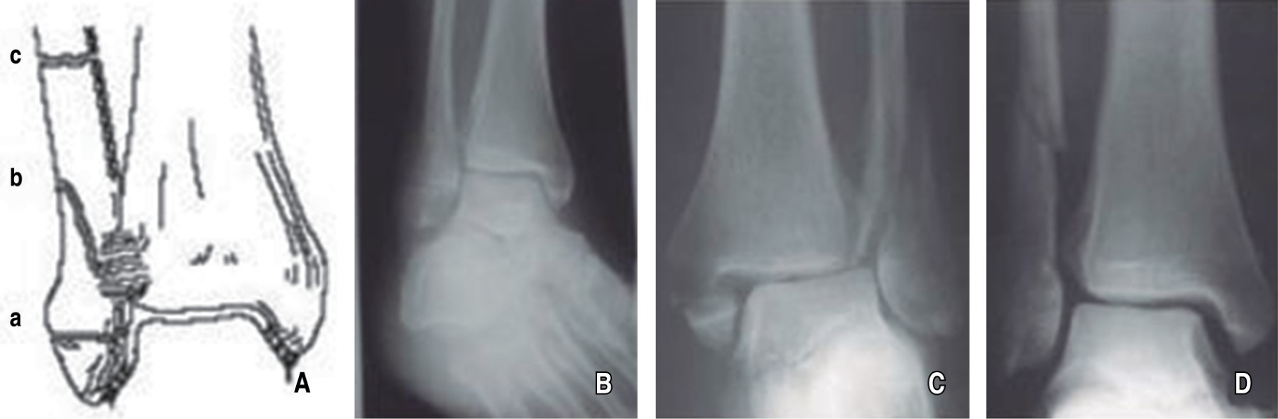 Ankle functionality associated with use of pneumatic orthopedic boot in