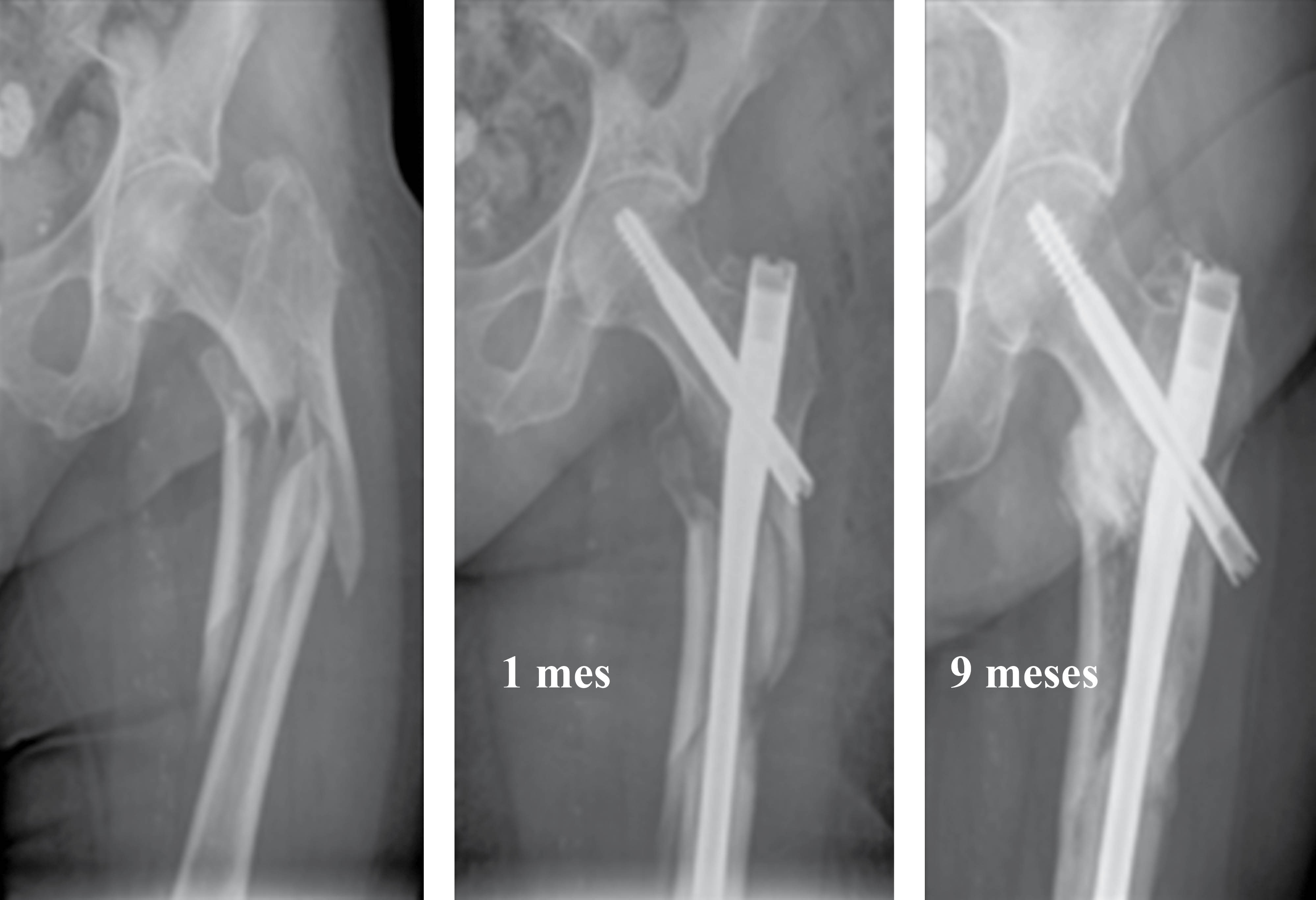 Comparative study of the treatment of subtrochanteric fractures in elderly  patients: reconstruction nail T2 vs long Gamma nail
