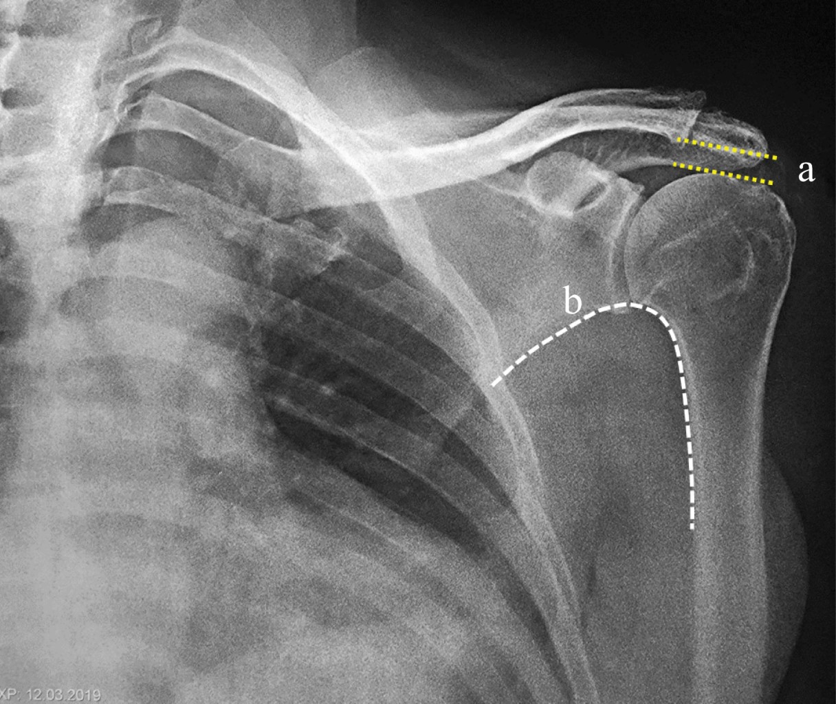 Massive rotator cuff injury arthroscopic treatment with upper capsular reconstruction