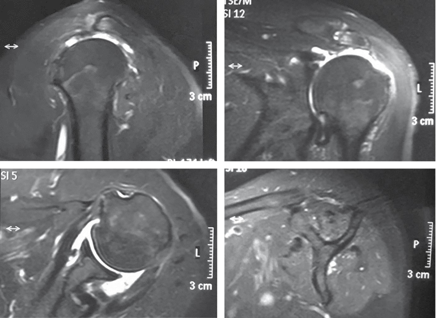 Massive rotator cuff injury arthroscopic treatment with upper capsular reconstruction