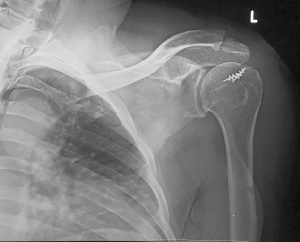 Massive rotator cuff injury arthroscopic treatment with upper capsular reconstruction