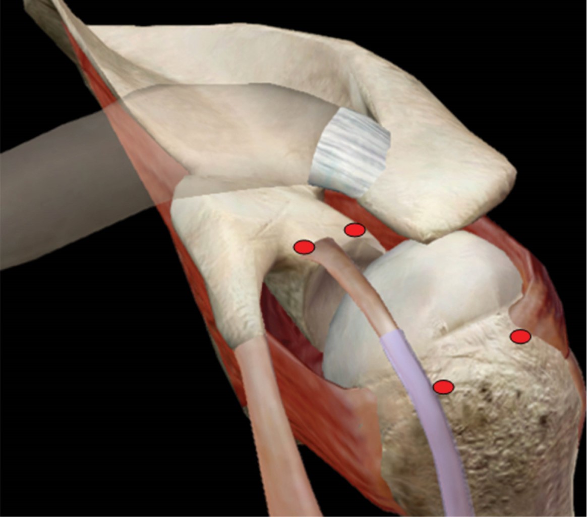 Massive rotator cuff injury arthroscopic treatment with upper capsular reconstruction
