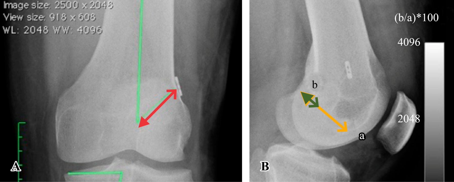 Radiographic evaluation of femoral and tibial tunnel position in