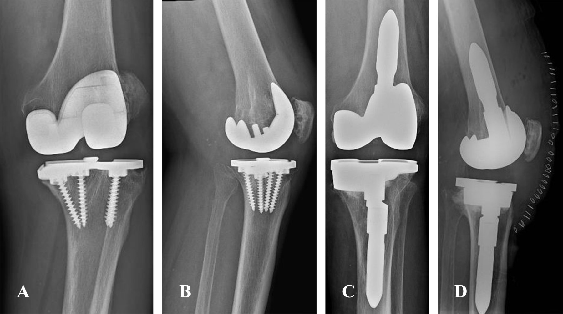 Preliminary results of hybrid fixation modular implant in revision knee